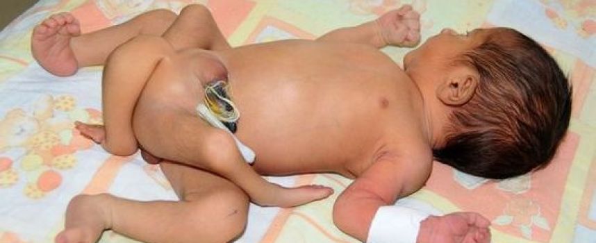 Photos du bébé pakistanais né avec 6 jambes