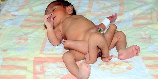 bébé pakistanais né avec 6 jambes